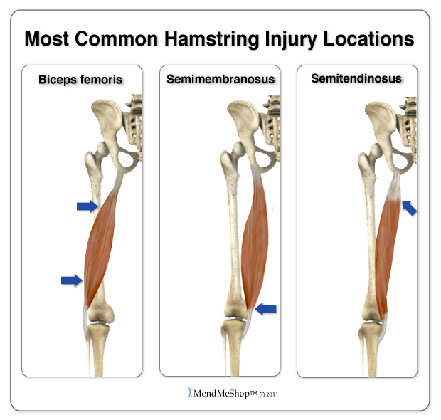 common injury areas hamstring